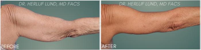 Before & After Arm Lift Case 387 Right Arm Straight View in St. Louis, MO