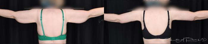 Before & After Arm Lift Case 399 Back View in St. Louis, MO