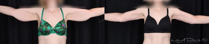 Anterior Brachioplasty with Dr. Prada