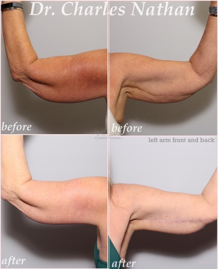 Before & After Arm Lift Case 436 Left Side View in St. Louis, MO