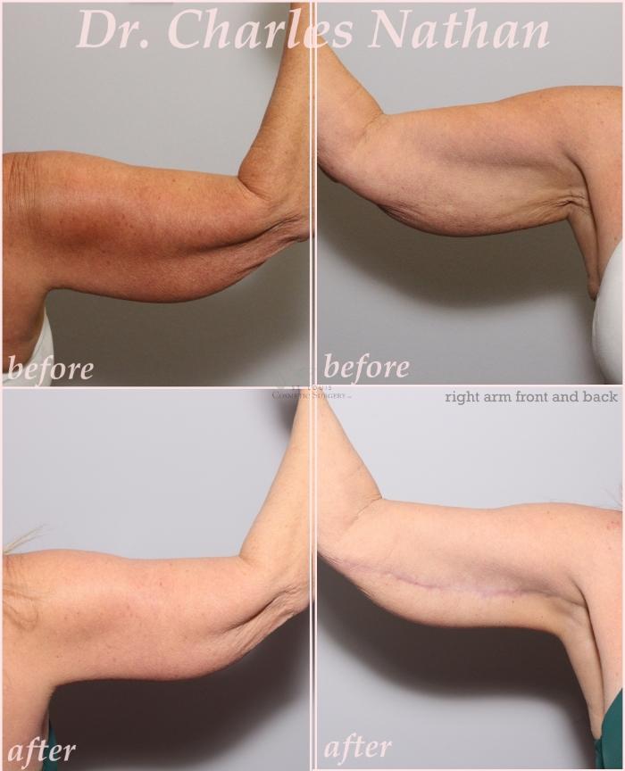 Before & After Arm Lift Case 436 Right Side View in St. Louis, MO