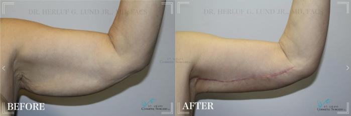 Before & After Arm Liposuction Case 298 View #1 View in St. Louis, MO