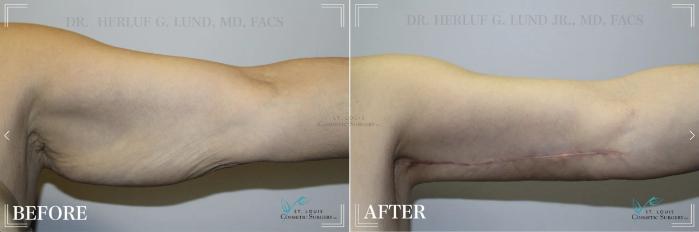 Before & After Arm Liposuction Case 298 View #2 View in St. Louis, MO