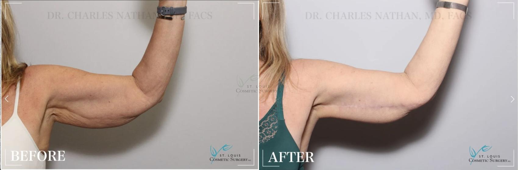 Before & After Arm Liposuction Case 299 View #1 View in St. Louis, MO
