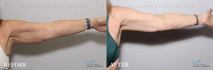 Before & After Arm Liposuction Case 299 View #2 View in St. Louis, MO