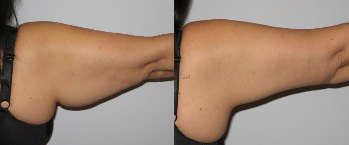 Before & After Arm Liposuction Case 30 View #1 View in St. Louis, MO