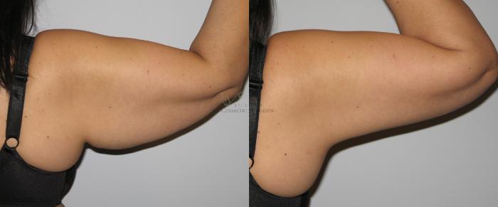 Before & After Arm Liposuction Case 30 View #2 View in St. Louis, MO