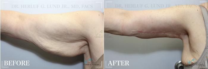 Before & After Arm Liposuction Case 319 View #1 View in St. Louis, MO
