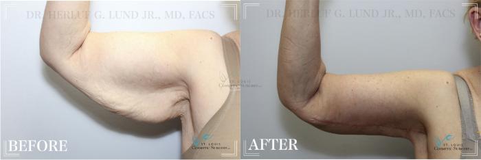Before & After Arm Liposuction Case 319 View #2 View in St. Louis, MO