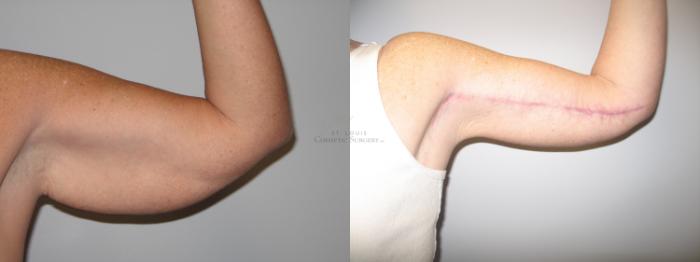 Before & After Arm Liposuction Case 66 View #1 View in St. Louis, MO