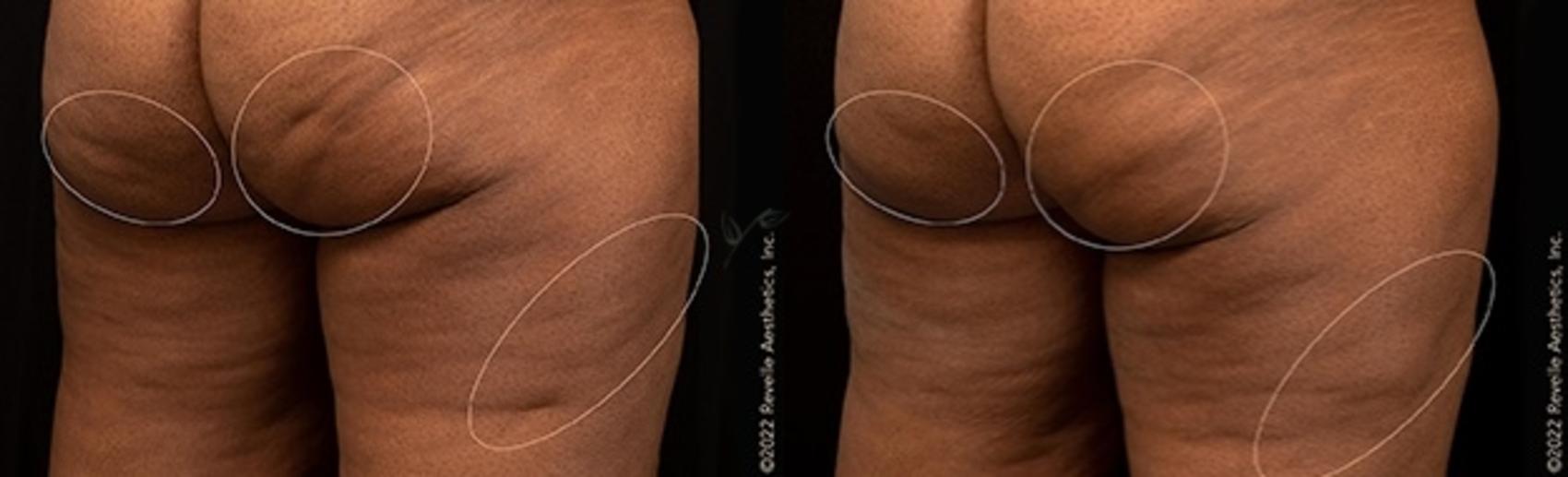 Before & After Avéli Cellulite Treatment Case 329 Back View in St. Louis, MO