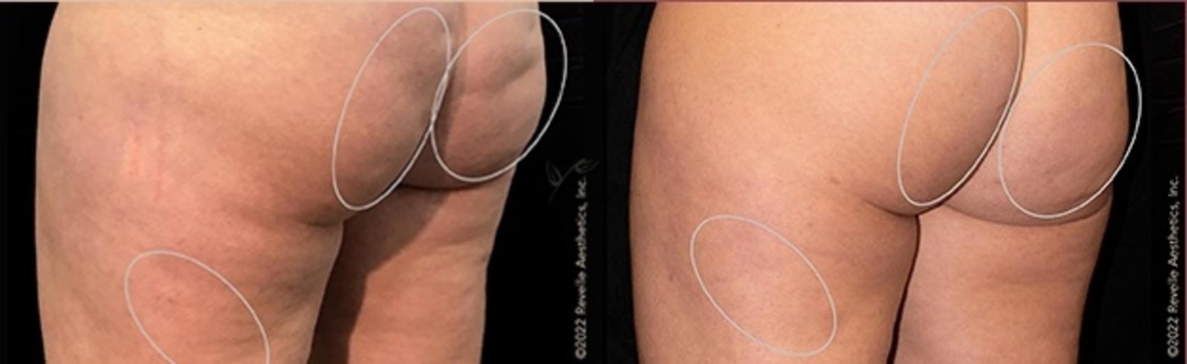 Before & After Avéli Cellulite Treatment Case 330 Back View in St. Louis, MO