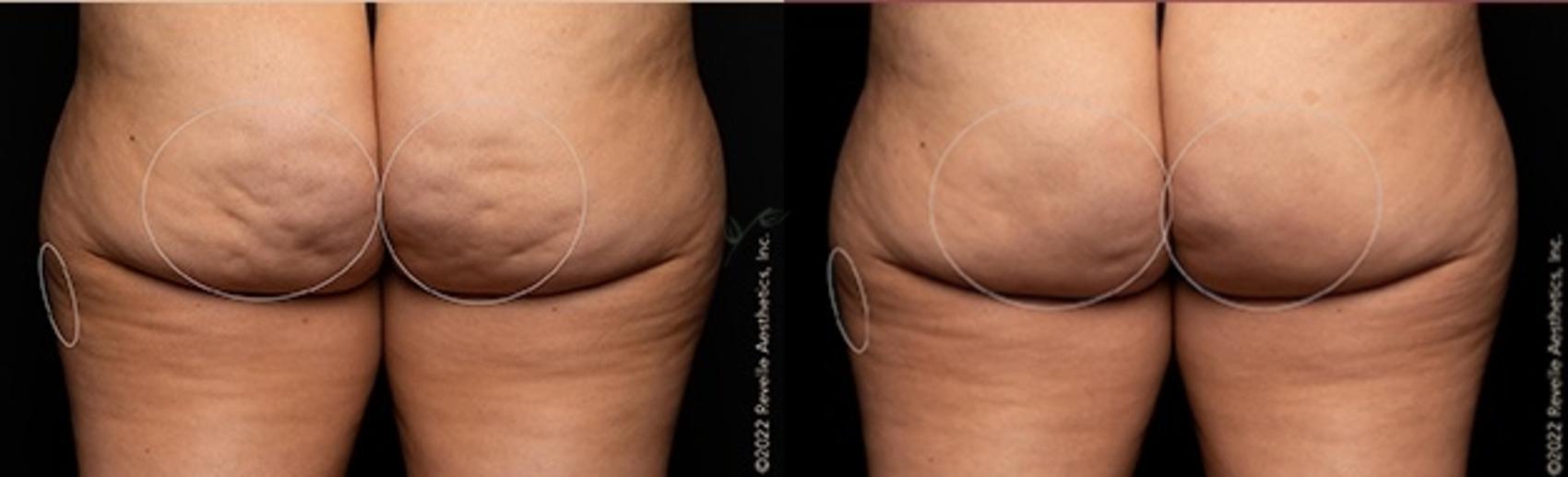 Before & After Avéli Cellulite Treatment Case 331 Back View in St. Louis, MO