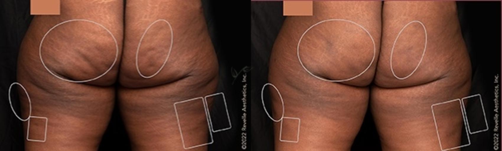 Before & After Avéli Cellulite Treatment Case 332 Back View in St. Louis, MO