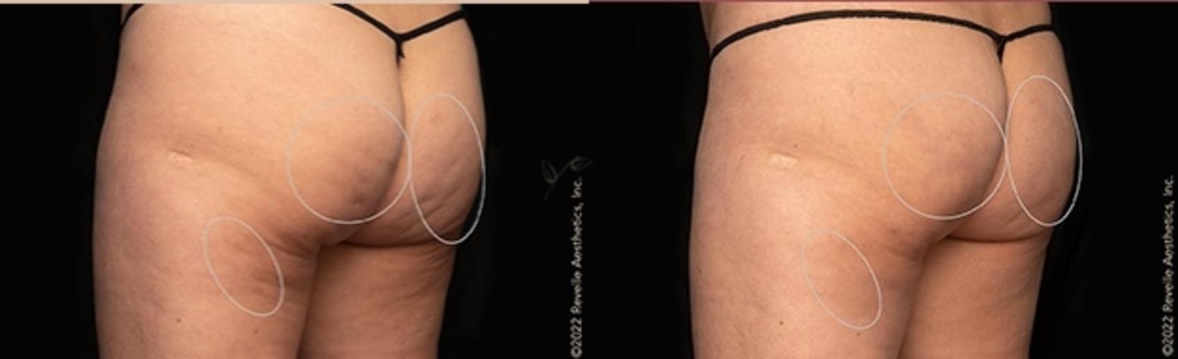 Before & After Avéli Cellulite Treatment Case 333 Back View in St. Louis, MO