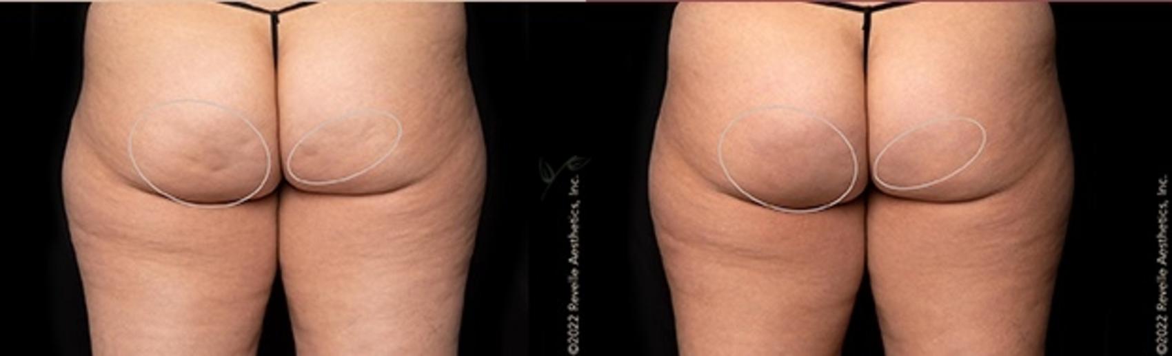 Before & After Avéli Cellulite Treatment Case 334 Back View in St. Louis, MO