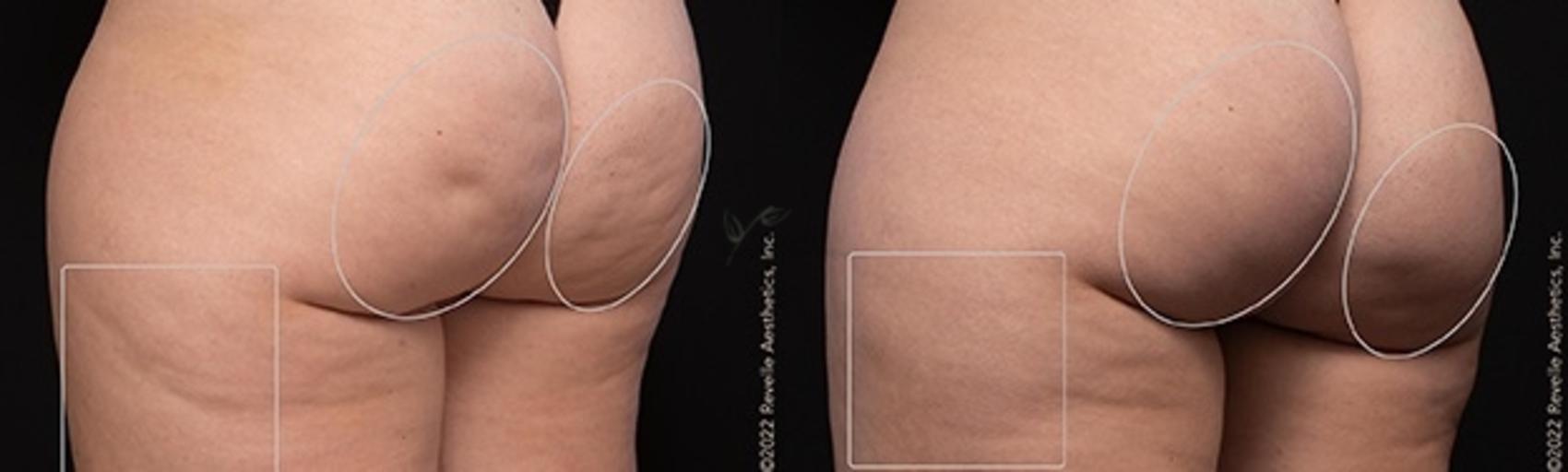 Before & After Avéli Cellulite Treatment Case 335 Back View in St. Louis, MO