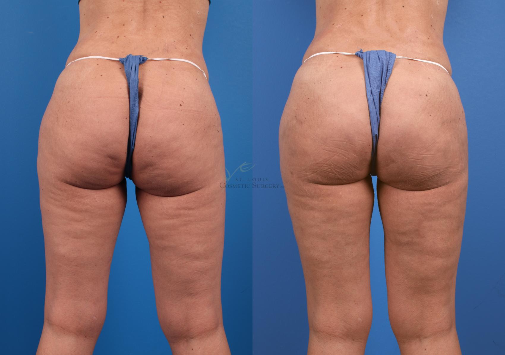 Before & After Mommy Makeover Case 379 Back View in St. Louis, MO