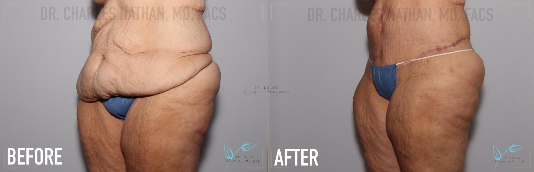 Body Lift Before & After Photo | St. Louis, MO | St. Louis Cosmetic Surgery