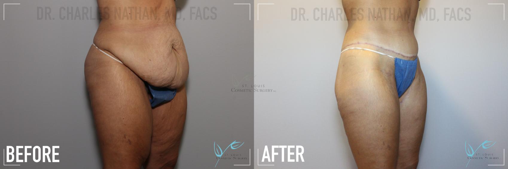Body Lift Before & After Photo | St. Louis, MO | St. Louis Cosmetic Surgery
