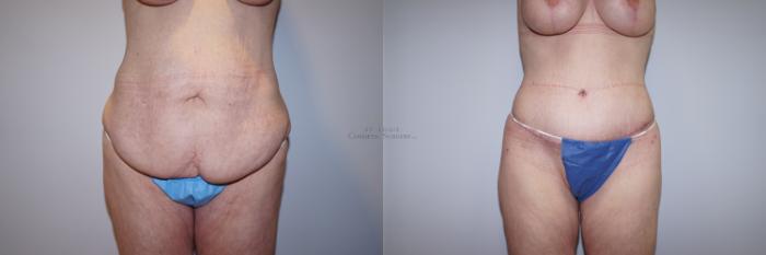 Before & After Tummy Tuck Case 289 Front View in St. Louis, MO