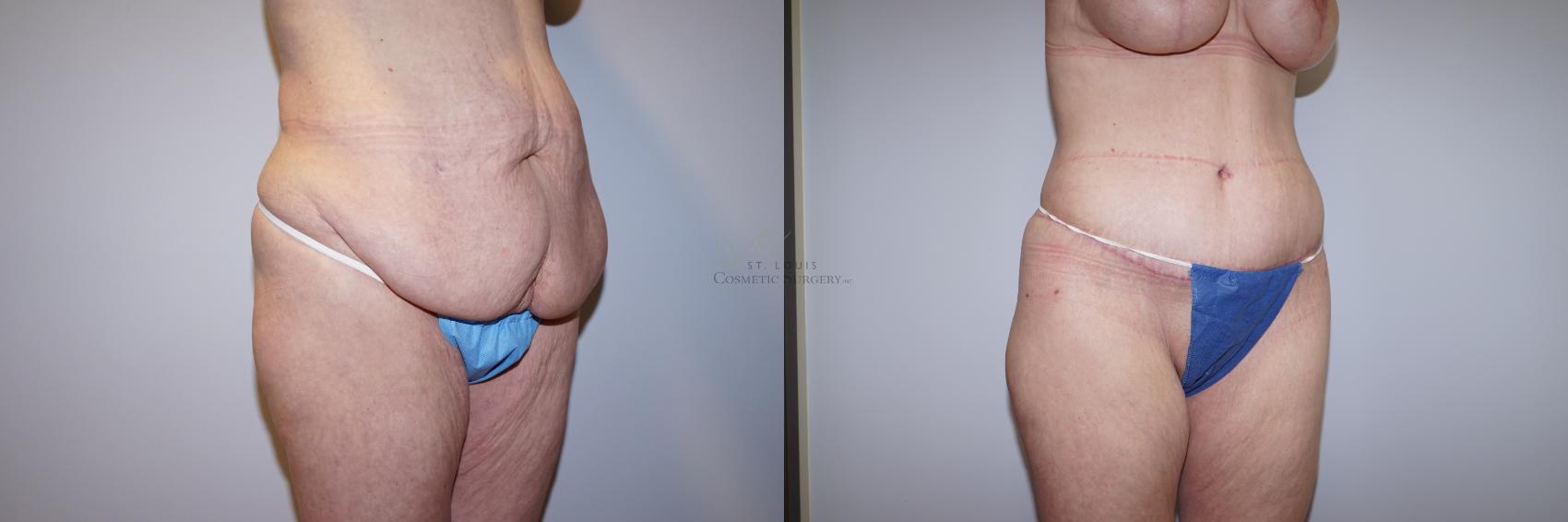 Before & After Tummy Tuck Case 289 Left Oblique View in St. Louis, MO