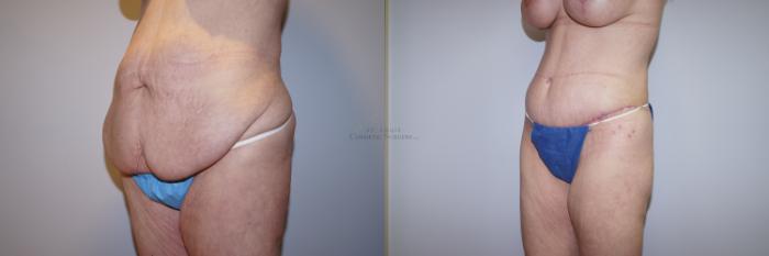 Before & After Body Lift Case 289 Right Oblique View in St. Louis, MO