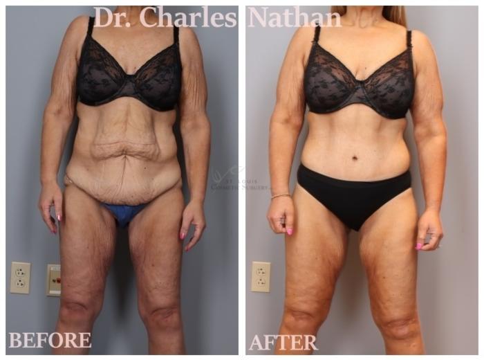 Before & After Liposuction Case 419 Front View in St. Louis, MO