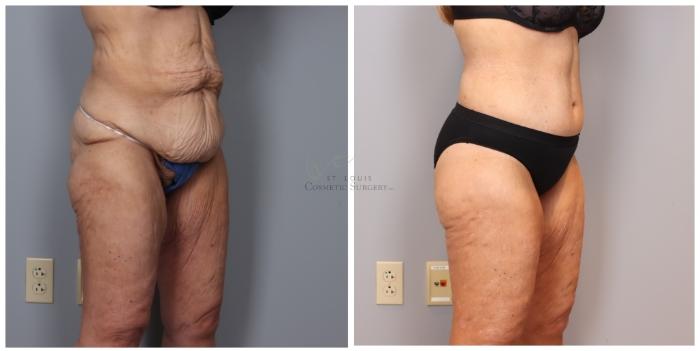 Before & After Liposuction Case 419 Left Oblique View in St. Louis, MO