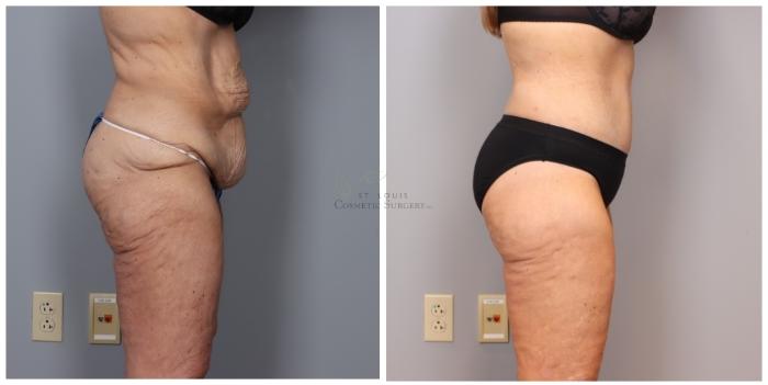 Before & After Liposuction Case 419 Left Side View in St. Louis, MO