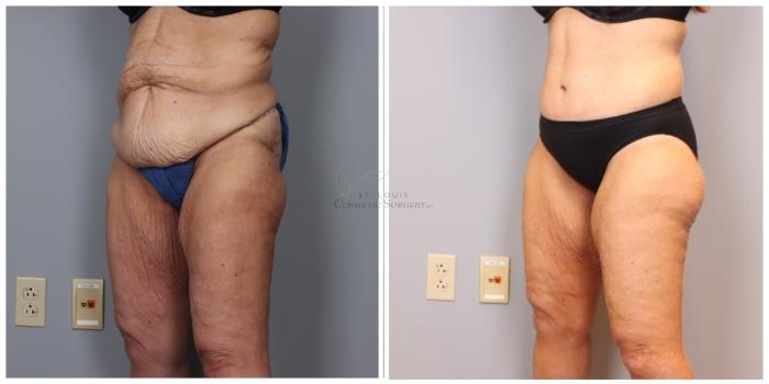 Before & After Liposuction Case 419 Right Oblique View in St. Louis, MO