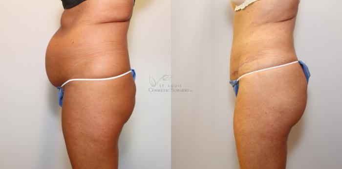 Before & After Brazilian Butt Lift Case 104 View #1 View in St. Louis, MO