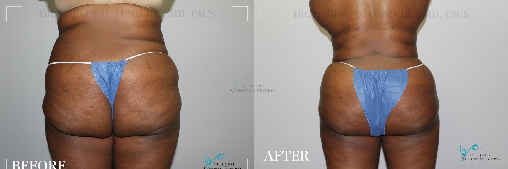 Before & After Brazilian Butt Lift Case 278 Back View in St. Louis, MO
