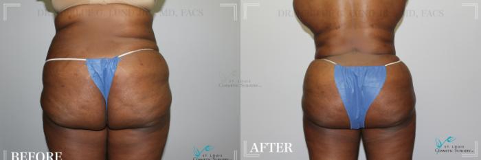 Before & After Brazilian Butt Lift Case 278 Back View in St. Louis, MO