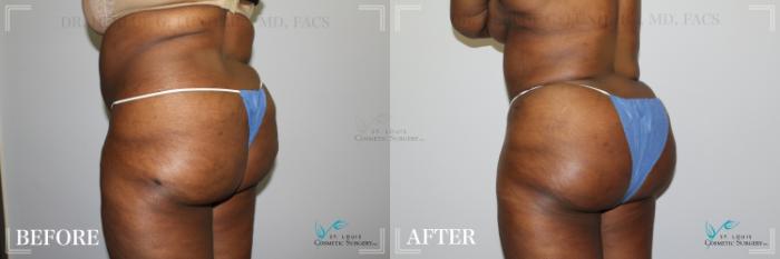 Before & After Brazilian Butt Lift Case 278 Left Oblique View in St. Louis, MO