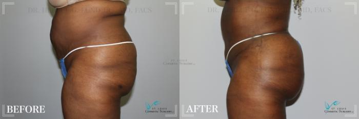 Before & After Brazilian Butt Lift Case 278 Left Side View in St. Louis, MO