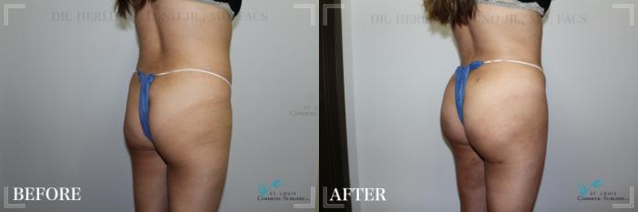 Before & After Brazilian Butt Lift Case 279 Right Oblique View in St. Louis, MO