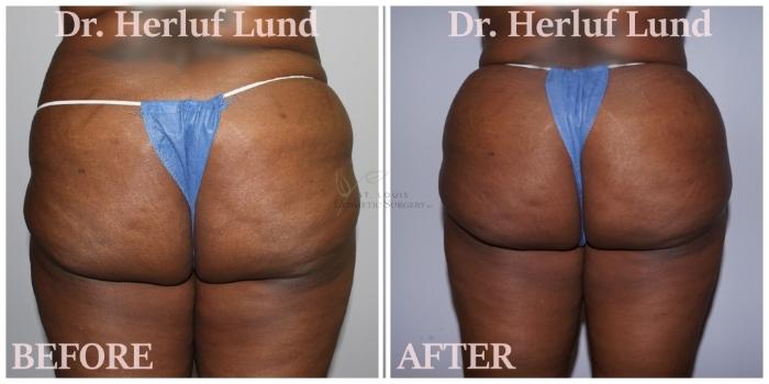 Before & After Brazilian Butt Lift Case 426 Back View in St. Louis, MO