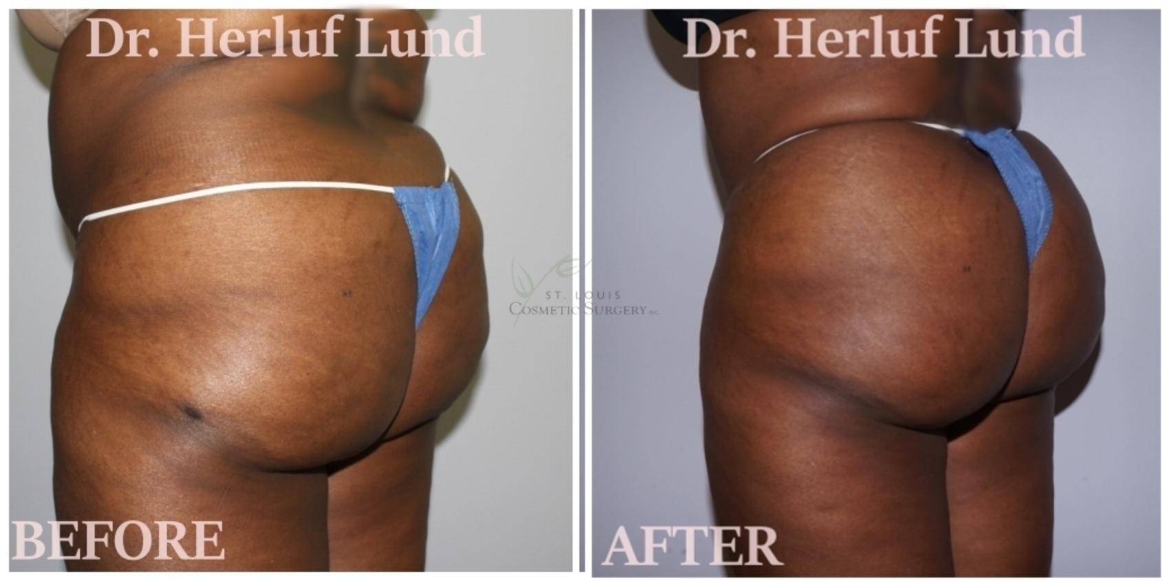 Before & After Brazilian Butt Lift Case 426 Left Oblique View in St. Louis, MO