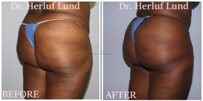 Before & After Brazilian Butt Lift Case 426 Right Oblique View in St. Louis, MO