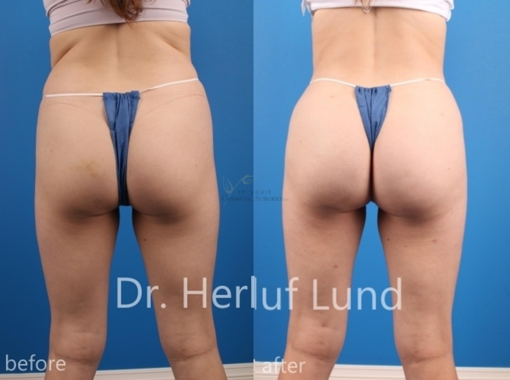 Before & After Brazilian Butt Lift Case 452 Front View in St. Louis, MO