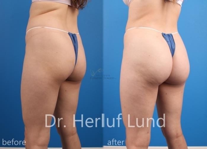 Before & After Brazilian Butt Lift Case 452 Left Oblique View in St. Louis, MO