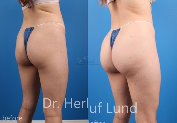 Before & After Brazilian Butt Lift Case 452 Right Oblique View in St. Louis, MO