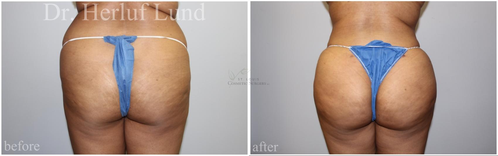 Before & After Brazilian Butt Lift Case 456 Front View in St. Louis, MO