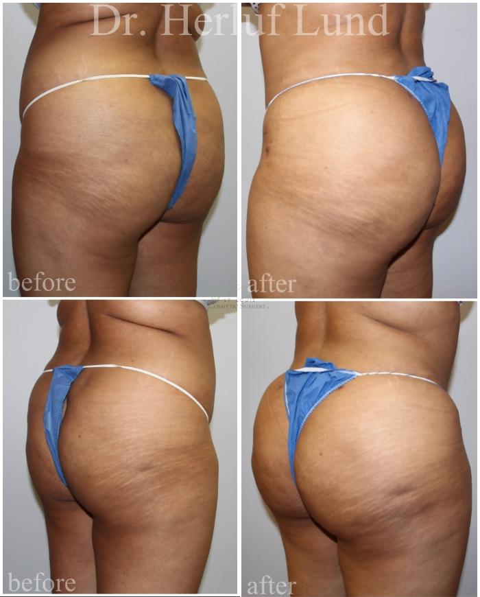 Before & After Brazilian Butt Lift Case 456 Left Oblique View in St. Louis, MO