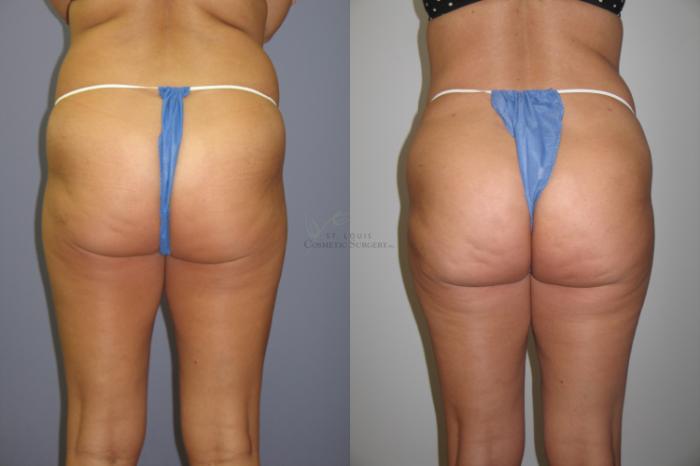 Before & After Brazilian Butt Lift Case 54 View #1 View in St. Louis, MO
