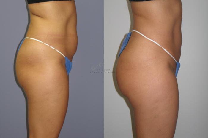 Before & After Brazilian Butt Lift Case 54 View #2 View in St. Louis, MO