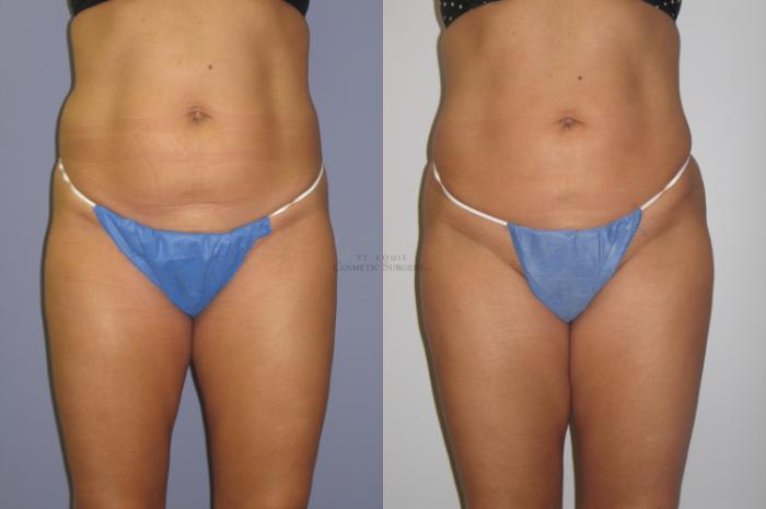 Before & After Brazilian Butt Lift Case 54 View #3 View in St. Louis, MO