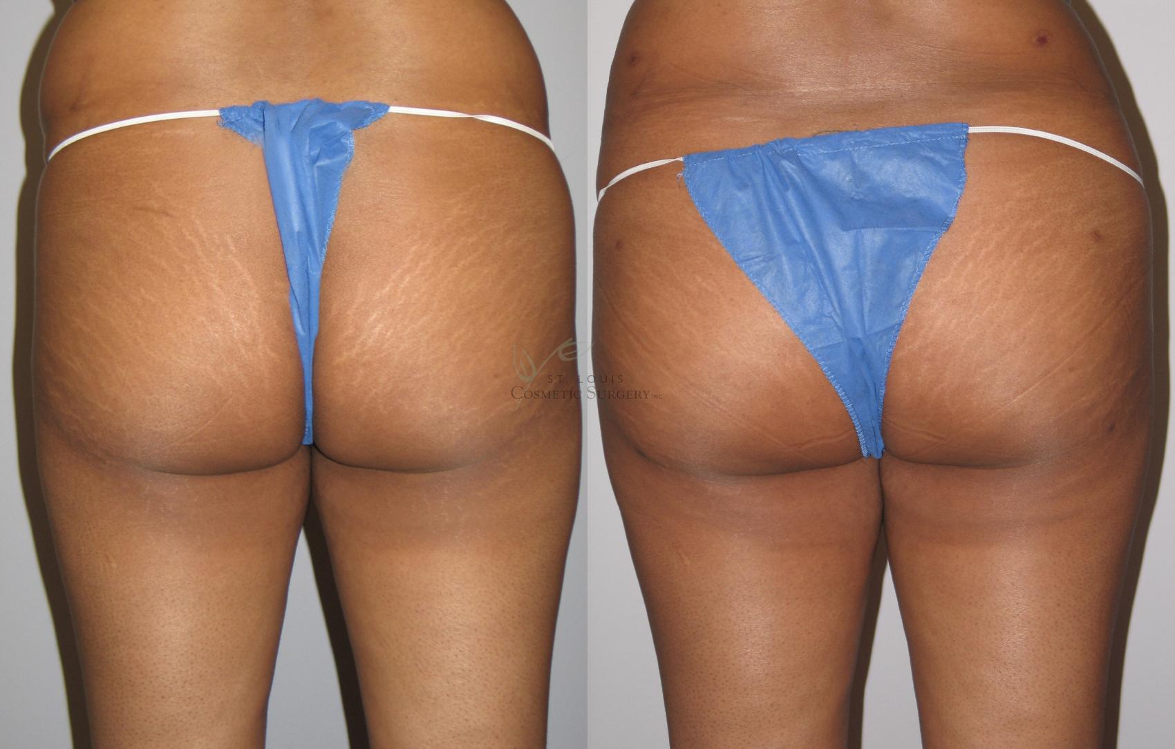 Brazilian Butt Lift Before & After Photo | St. Louis, MO | St. Louis Cosmetic Surgery