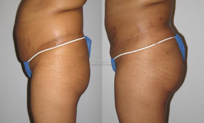 Before & After Brazilian Butt Lift Case 69 View #2 View in St. Louis, MO
